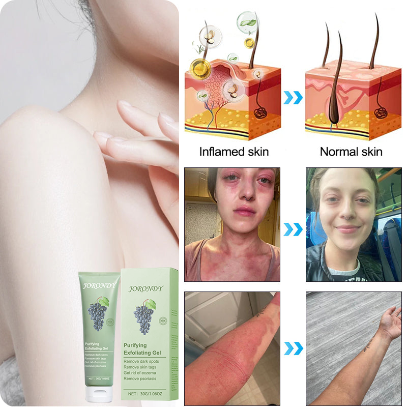 🌲🌲🌲Pročišćavajući gel za piling za Acanthosis Nigricans, piling, tamne mrlje, kožne mrlje i ekceme✨✨