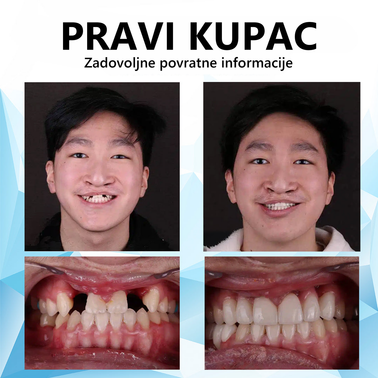 💎🦷𝐁𝐢𝐤𝐞𝐧𝐝𝐚™ Silikonski set za učvršćivanje proteza (⏰Ograničeno vrijeme popusta! Preostalo 30 minuta⏰)