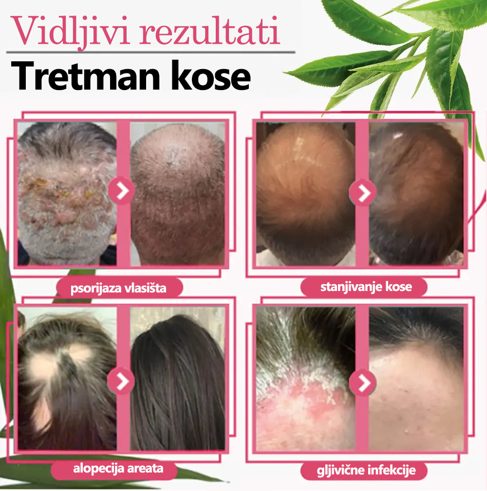 𝙇𝙀𝙁𝙐𝙉™🐝 Luxe Bee venom Scalp Treatment HairGrᴏᴡth sprej za kosu (Požurite, 80% POPUSTA - Još samo 30 minuta 🫧)