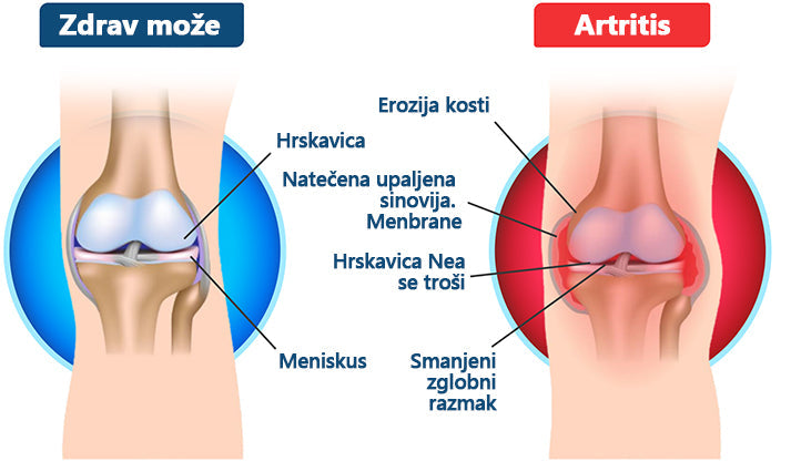 🔥🔥ArthroFree™ Krema za zacjeljivanje kostiju protiv bolova s pčelinjim otrovom🐝(Posebno za starije osobe & AAOS preporučuje)