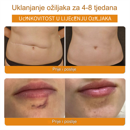 𝙇𝙀𝙁𝙐𝙉™ Krema za uklanjanje ožiljaka (Preporučeno od strane BAD-a) (🌸Zadnji dan promocije 80% popusta🌸)