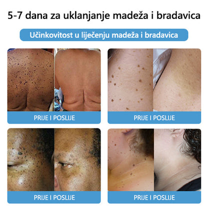 [🍀Službena Trgovina Marke🍀] 🐝🐝LEFUN™ Krema za liječenje madeža i bradavica s pčelinjim otrovom(👨‍⚕AAD PREPORUČUJE)2