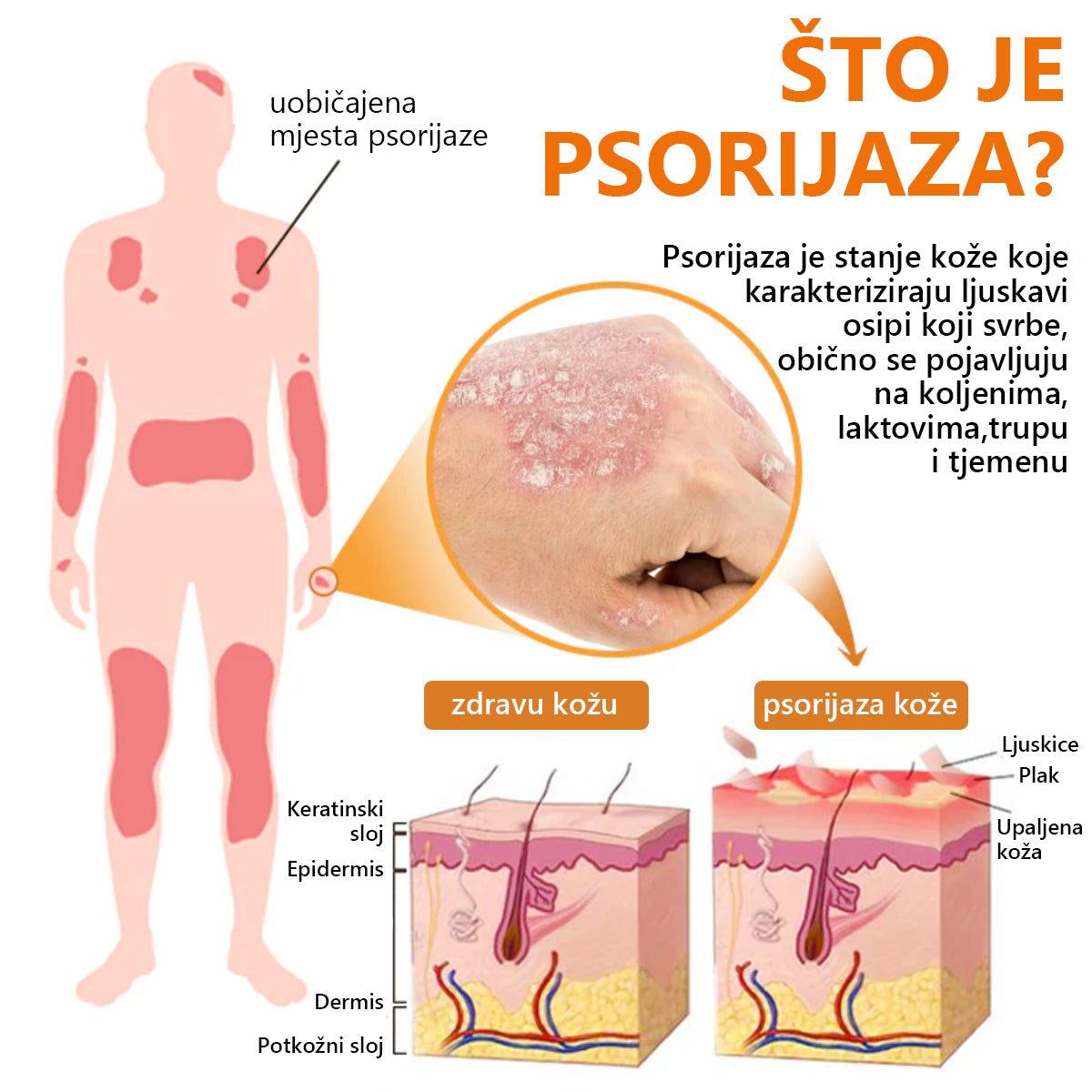 (🔥 60% Popusta na zadnji dan kupnje paketa 🔥) LEFUN™ PsoriaHeal sprej za psorijazu pro🐝Globalna dostava