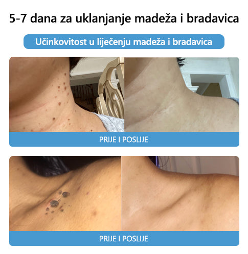 [🍀Službena Trgovina Marke🍀] 🐝🐝LEFUN™ Krema za liječenje madeža i bradavica s pčelinjim otrovom(👨‍⚕AAD PREPORUČUJE)2