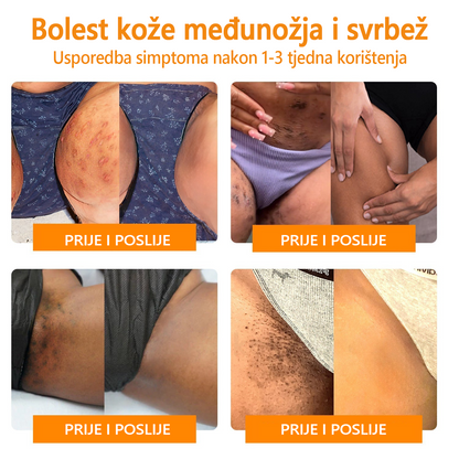 🌈LIPOGO™ krema za uklanjanje bradavica i oznaka s pčelinjim otrovom (👨‍⚕Pogodna za sve tipove kože) 🐝 (🔥Prošlog dana popust od 70%)