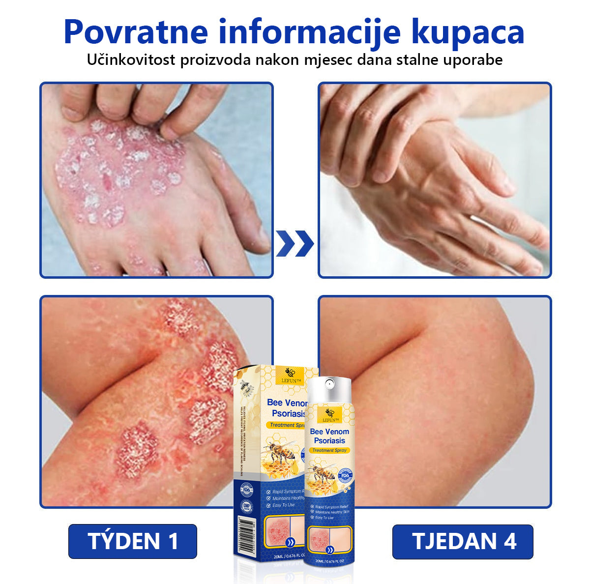 (🔥 60% Popusta na zadnji dan kupnje paketa 🔥) LEFUN™ PsoriaHeal sprej za psorijazu pro🐝Globalna dostava