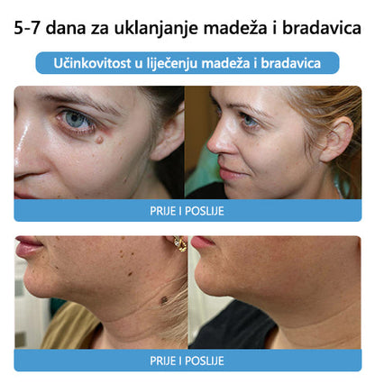 [🍀Službena Trgovina Marke🍀] 🐝🐝LEFUN™ Krema za liječenje madeža i bradavica s pčelinjim otrovom(👨‍⚕AAD PREPORUČUJE)2