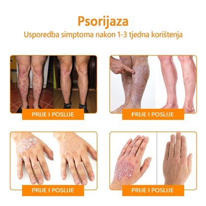 🌈LIPOGO™ krema za uklanjanje bradavica i oznaka s pčelinjim otrovom (👨‍⚕Pogodna za sve tipove kože) 🐝 (🔥Prošlog dana popust od 70%)