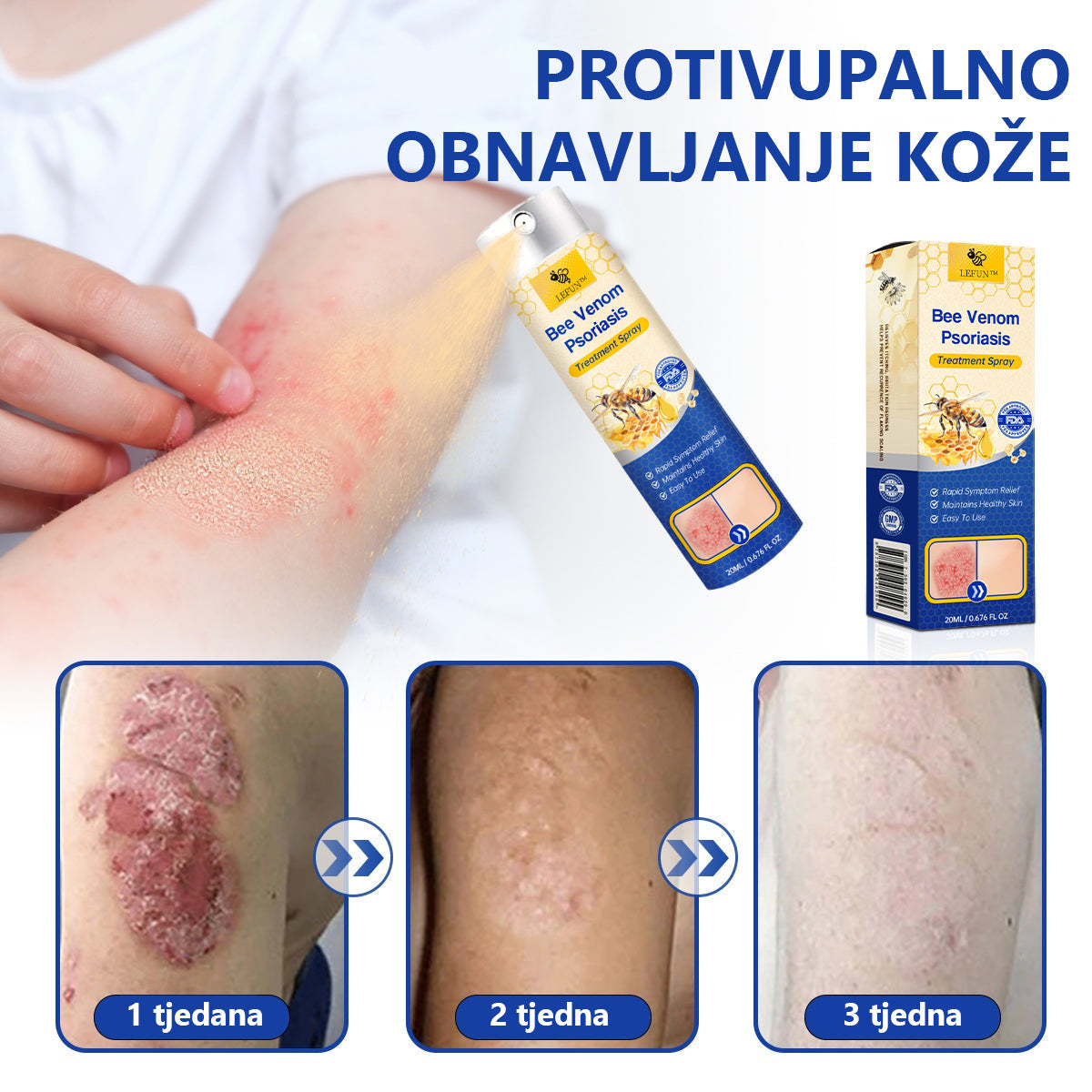 (🔥 60% Popusta na zadnji dan kupnje paketa 🔥) LEFUN™ PsoriaHeal sprej za psorijazu pro🐝Globalna dostava